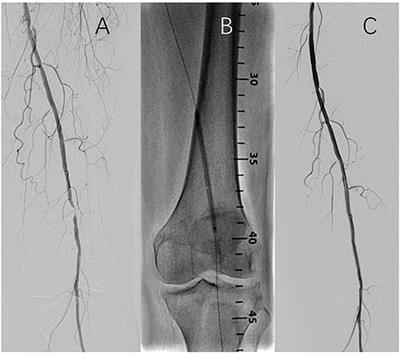 Twelve-Month Results From the First-in-China Prospective, Multi-Center, Randomized, Controlled Study of the FREEWAY Paclitaxel-Coated Balloon for Femoropopliteal Treatment